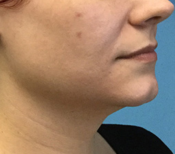 Exilis Ultra™ Before and After Photos - Salem, NH