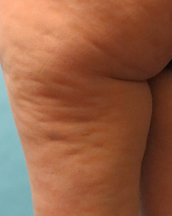 Cellulite Treatment Before and After Photos - Salem, NH