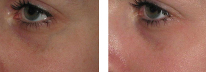 Vein Treatment Before & After Vein Treatment Before & After