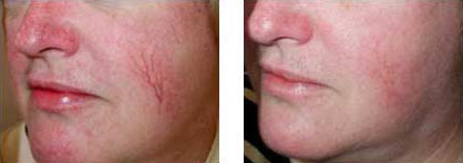 Vein Treatment Before & After Vein Treatment Before & After