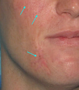 Photofacial/Ipl Before and After Photos NH