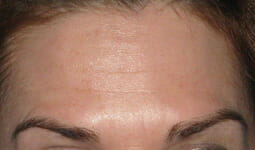 BOTOX® Cosmetic Before and After Photos NH