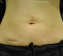 Exilis Ultra™ Skin Tightening Treatment Before & After
