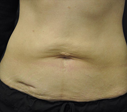 Exilis Ultra™ Skin Tightening Before and After Photos - Salem, NH