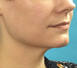 Exilis Ultra™ Before and After Photos - Salem, NH