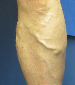 Leg Veins Treatment Before and After Photos - Salem, NH