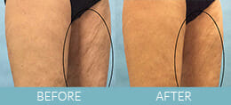 Cellulite Treatment Gallery