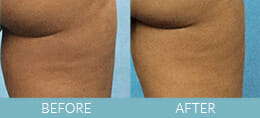 Cellulite Treatment Gallery