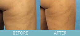 Cellulite Treatment Gallery