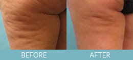 Cellulite Treatment Gallery