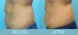 CoolSculpting<sup>®</sup> Gallery