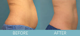 CoolSculpting<sup>®</sup> Gallery