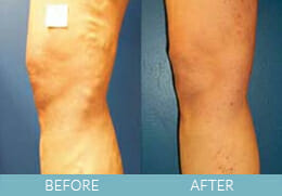 Leg Veins Gallery