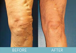 Leg Veins Gallery