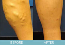 Leg Veins Gallery