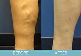 Leg Veins Gallery