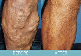 Leg Veins Gallery