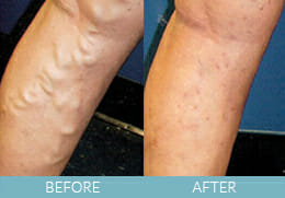 Leg Veins Gallery