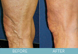 Leg Veins Gallery