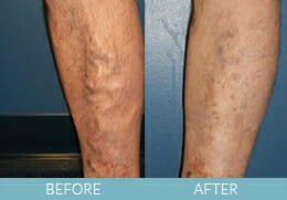 Leg Veins Gallery