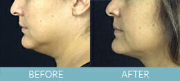 Precision Tx<sup>®</sup> Neck Lift Gallery