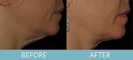 Skin Tightening Gallery