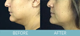 Skin Tightening Gallery