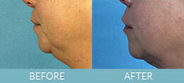 Skin Tightening Gallery