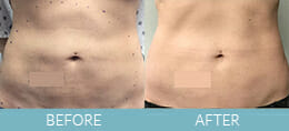 Skin Tightening Gallery
