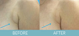 Skin Tightening Gallery