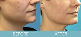 Skin Tightening Gallery