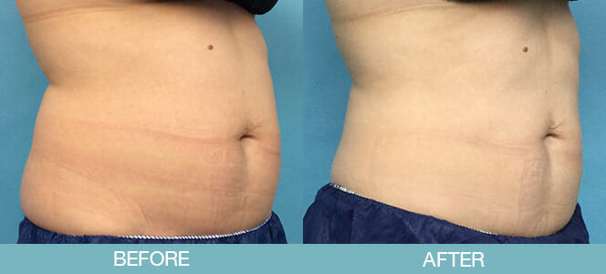 CoolSculpting® Before and After - New Hampshire, Dr. Miller