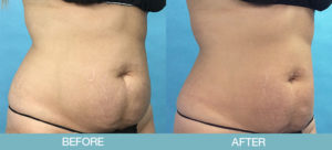 CoolSculpting<sup>®</sup> Gallery
