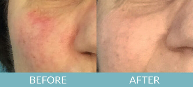 Laser / IPL Gallery - AVCMD