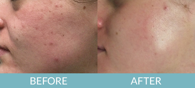 PCA Skin® Peel Before and After, Salem, NH
