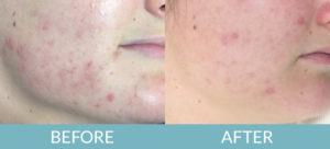 Microdermabrasion & Chemical Peels Gallery