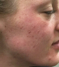 Microdermabrasion & Chemical Peels Before and After Photos NH