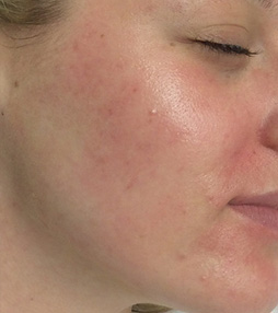 Microdermabrasion & Chemical Peels Before and After Photos NH