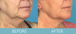 Precision Tx<sup>®</sup> Neck Lift Gallery