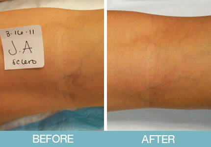 Spider Vein Treatment Before and After - New Hampshire, Dr. Miller