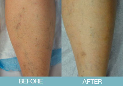 Spider Vein Treatment Before and After - New Hampshire, Dr. Miller