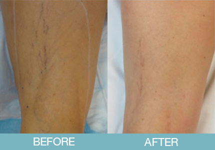 Spider Vein Treatment Before and After - New Hampshire, Dr. Miller