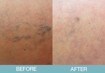 Spider Vein Treatment Before and After - New Hampshire, Dr. Miller