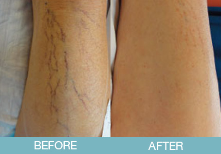 Spider Vein Treatment Before and After - New Hampshire, Dr. Miller
