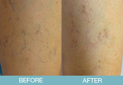 Spider Vein Treatment Before and After - New Hampshire, Dr. Miller