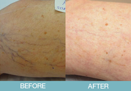 Spider Vein Treatment Before and After - New Hampshire, Dr. Miller