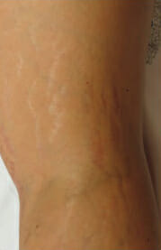 Spider Vein Treatment Before & After