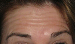 BOTOX® Cosmetic Before and After Photos NH