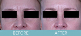 Exilis Ultra™ Skin Tightening Gallery