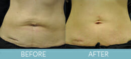 Exilis Ultra™ Skin Tightening Gallery